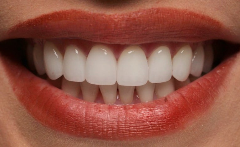 Advanced digital smile design services from the Best Dental Lab, creating customized, natural-looking smiles