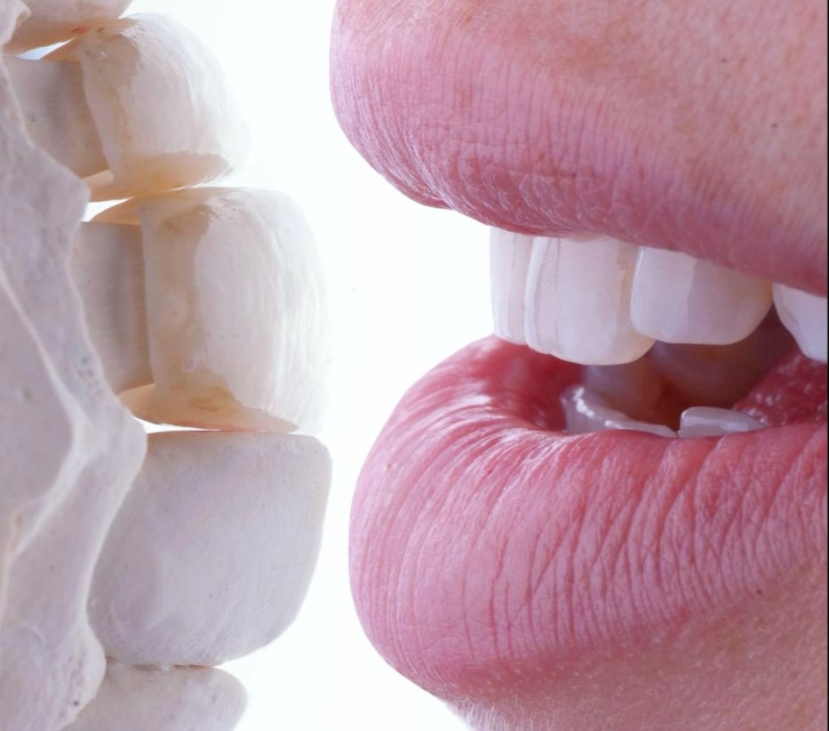 Premium Emax ceramic crown by the Best Dental Lab, designed for natural translucency and a perfect smile.